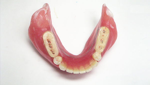 当院が取り組む「無痛・超吸着入れ歯」と一般的な入れ歯の違い」3