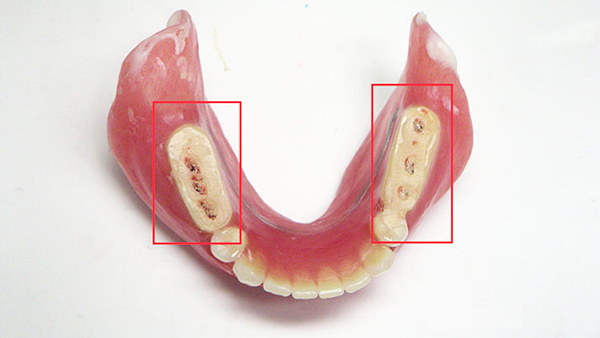当院が取り組む「無痛・超吸着入れ歯」と一般的な入れ歯の違い」4